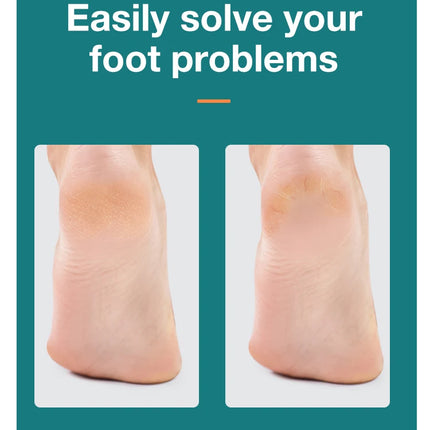 MR.GREEN Foot File Double Sided Callus Remover For Dead Skin Professional Pedicure Tools Callous Scraper Foot Sander Heel Filer
